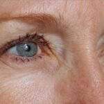 CO2 Laser for Under Eye Wrinkles Before and After Results