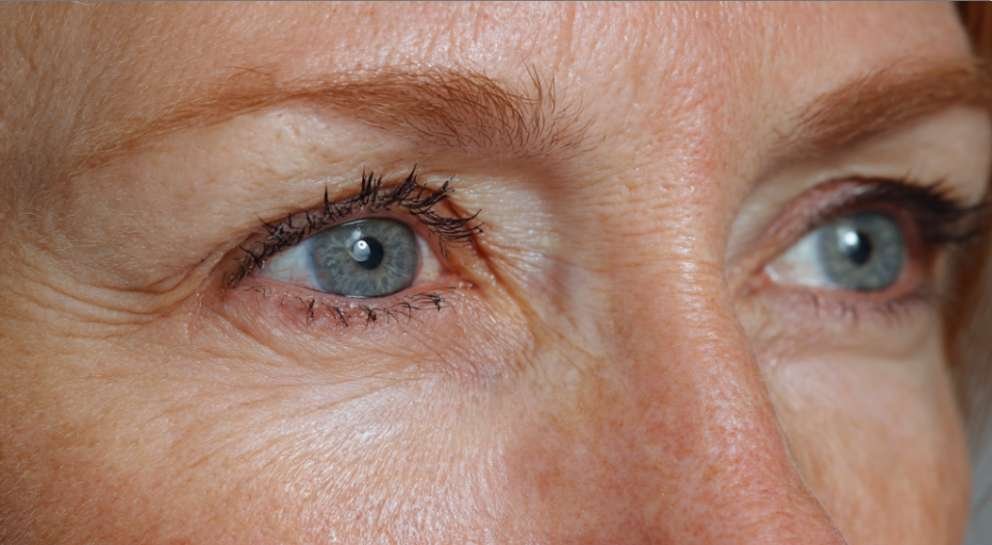 CO2 Laser for Under Eye Wrinkles Before and After Results