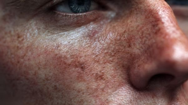 Complications & Side Effects of CO2 Laser Treatments