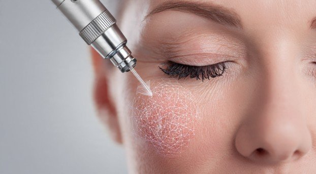 What Is CO2 Laser Treatment for the Eye Area