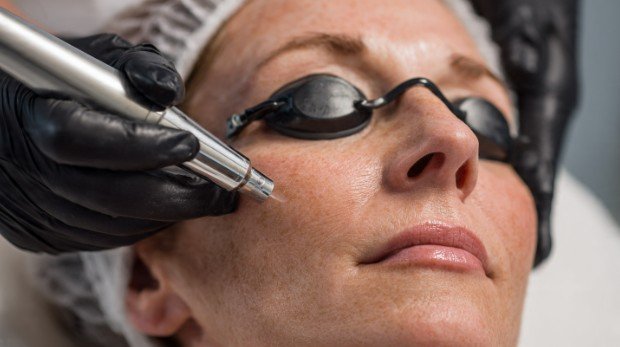 What to Expect Before CO2 Laser Treatment for the Face