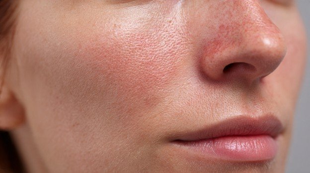 What to Expect Immediately After CO2 Laser Treatment