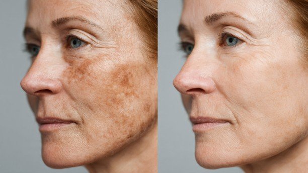 Why Choose a CO2 Laser for Face